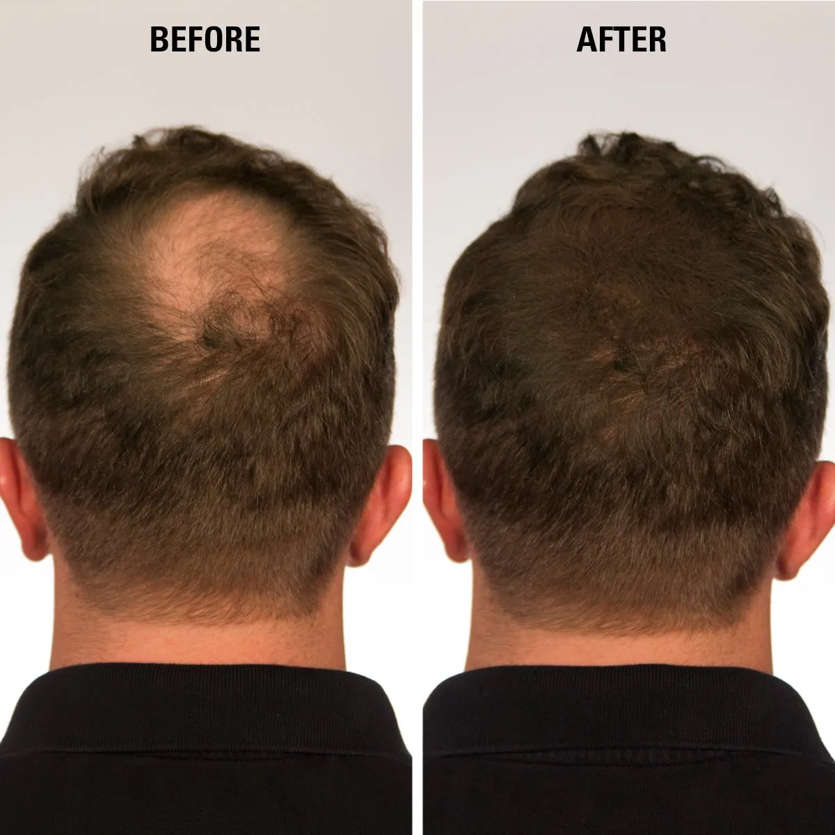 Hair Thickening Fiber - Hair Loss Concealer for Men & Women - Black, 15g